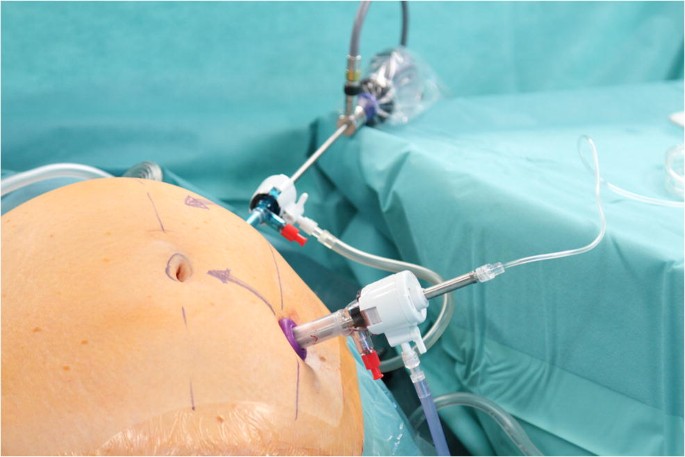 Pressurized Intraperitoneal Aerosol Chemotherapy