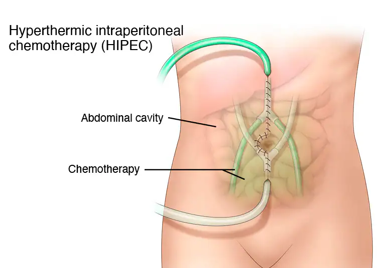 Hyperthermic Intraperitoneal Chemotherapy