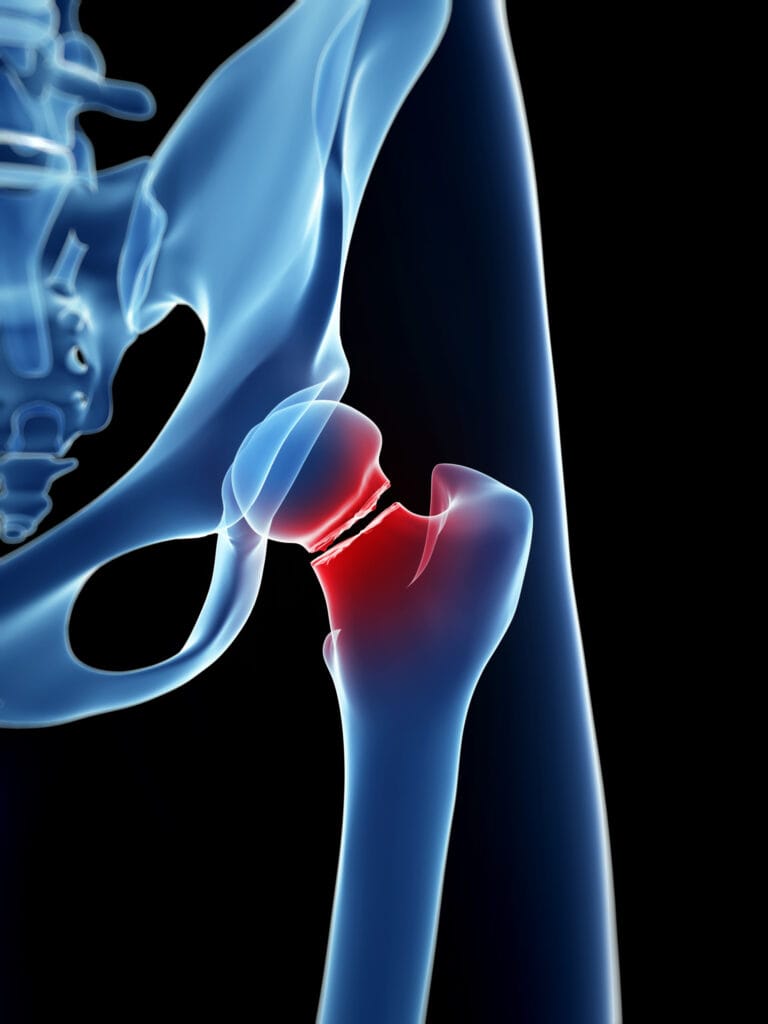 Joint Replacement And Orthopaedics